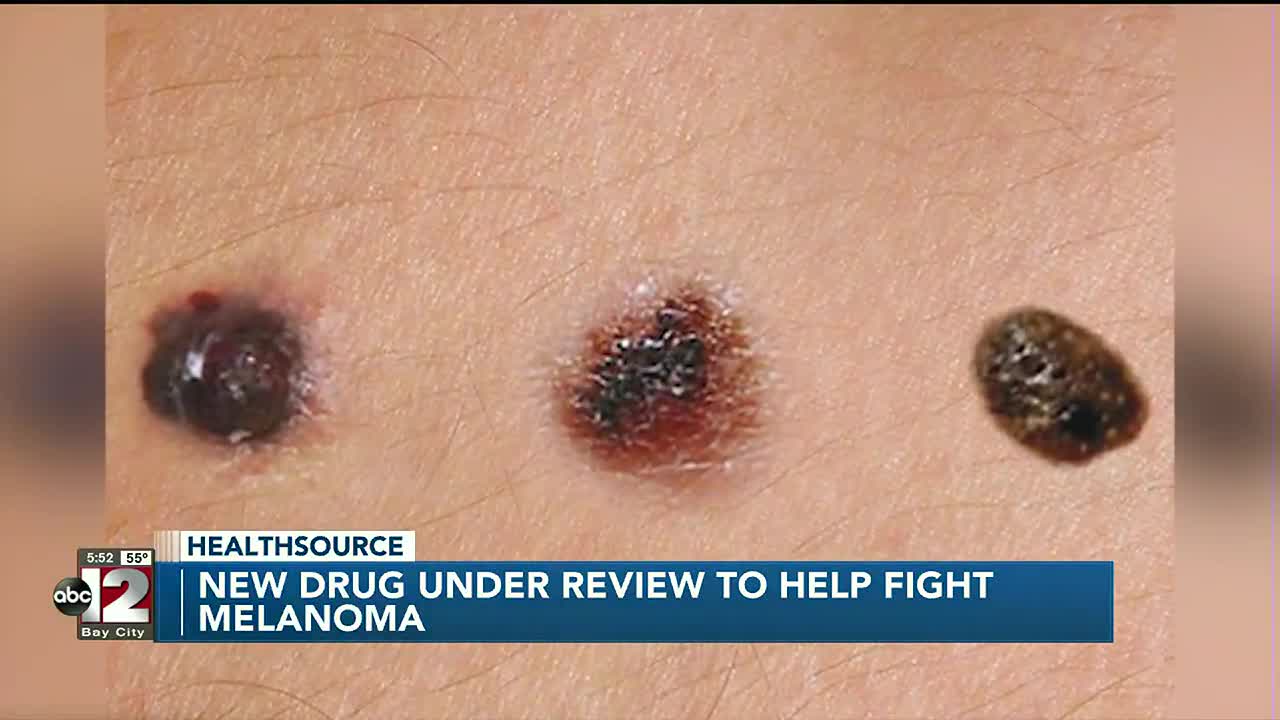 New Drug Kills Metastatic Melanoma