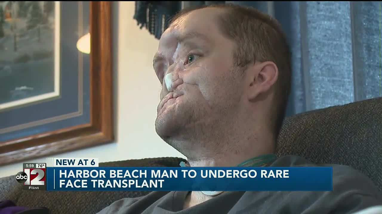 Harbor Beach Man Hoping For Face Transplant After Surviving Suicide Attempt