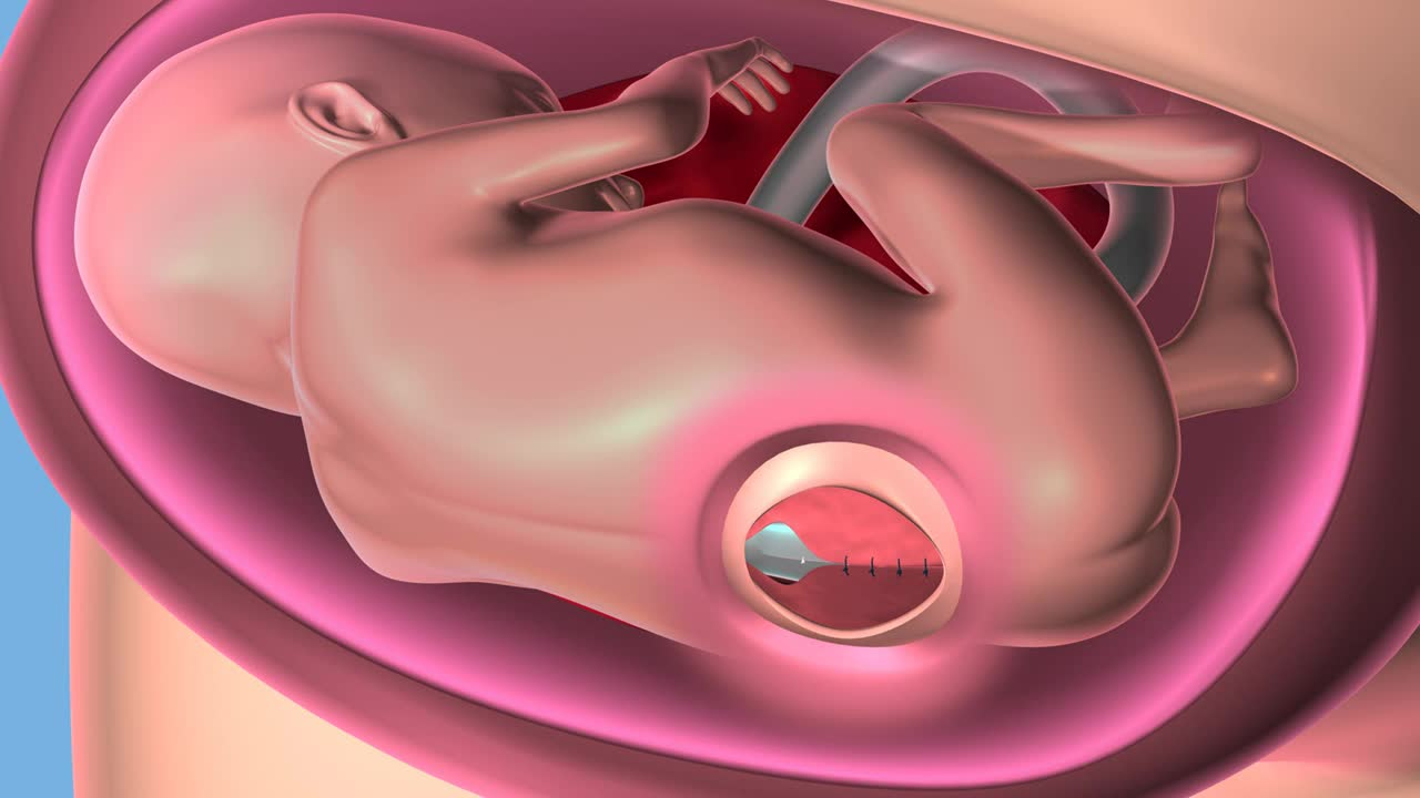Cleveland Clinic Performs First In Utero Fetal Surgery To Repair Birth Defect Video